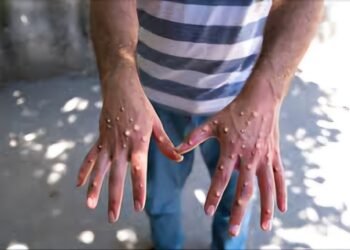 Épidémie de Mpox : des prémices en Guinée ?