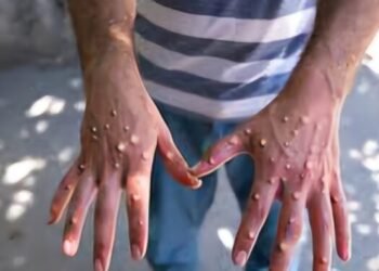 Guinée : le pays enregistre son premier cas de MPOX